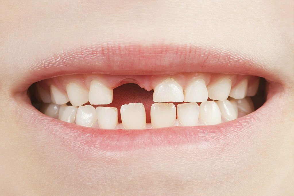 How To Fix Loose Teeth: Your Guide For Effective Oral Hacks