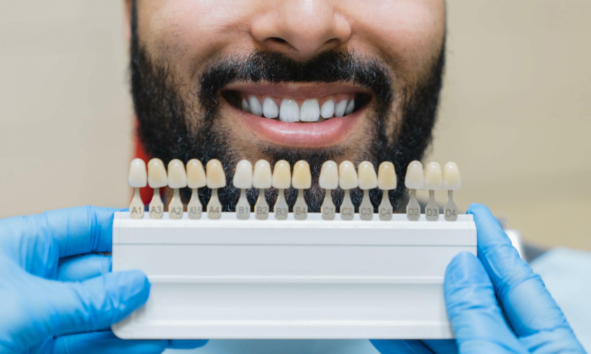 How to Find the Best Porcelain Veneers in Kansas City_FI