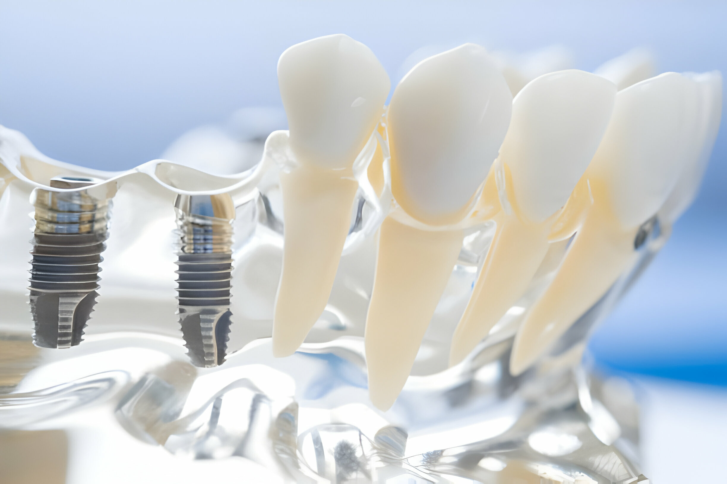 Securing Your Smile: A Guide On How To Fix Loose Dental Implants_1