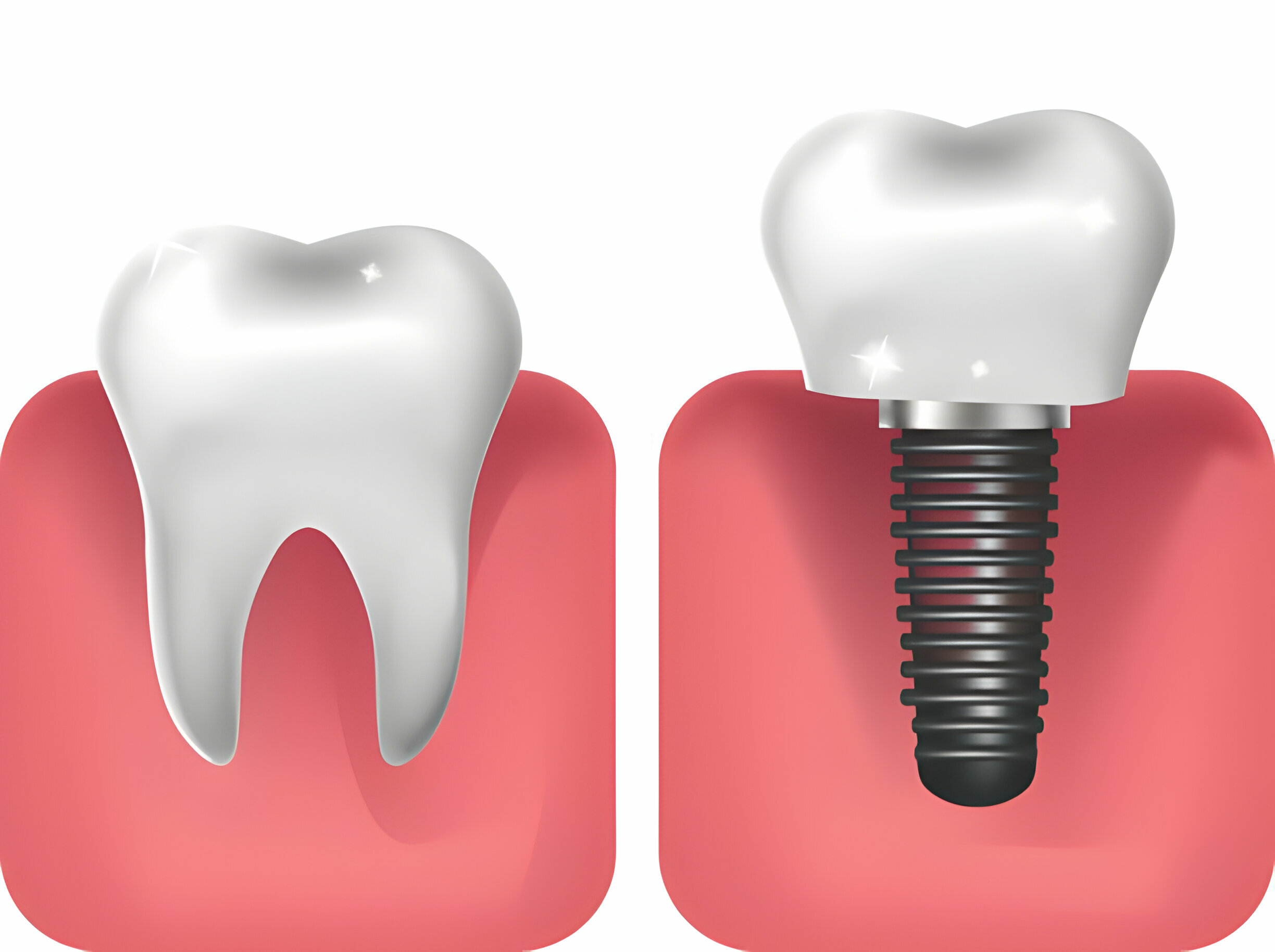 Securing Your Smile: A Guide On How To Fix Loose Dental Implants_2