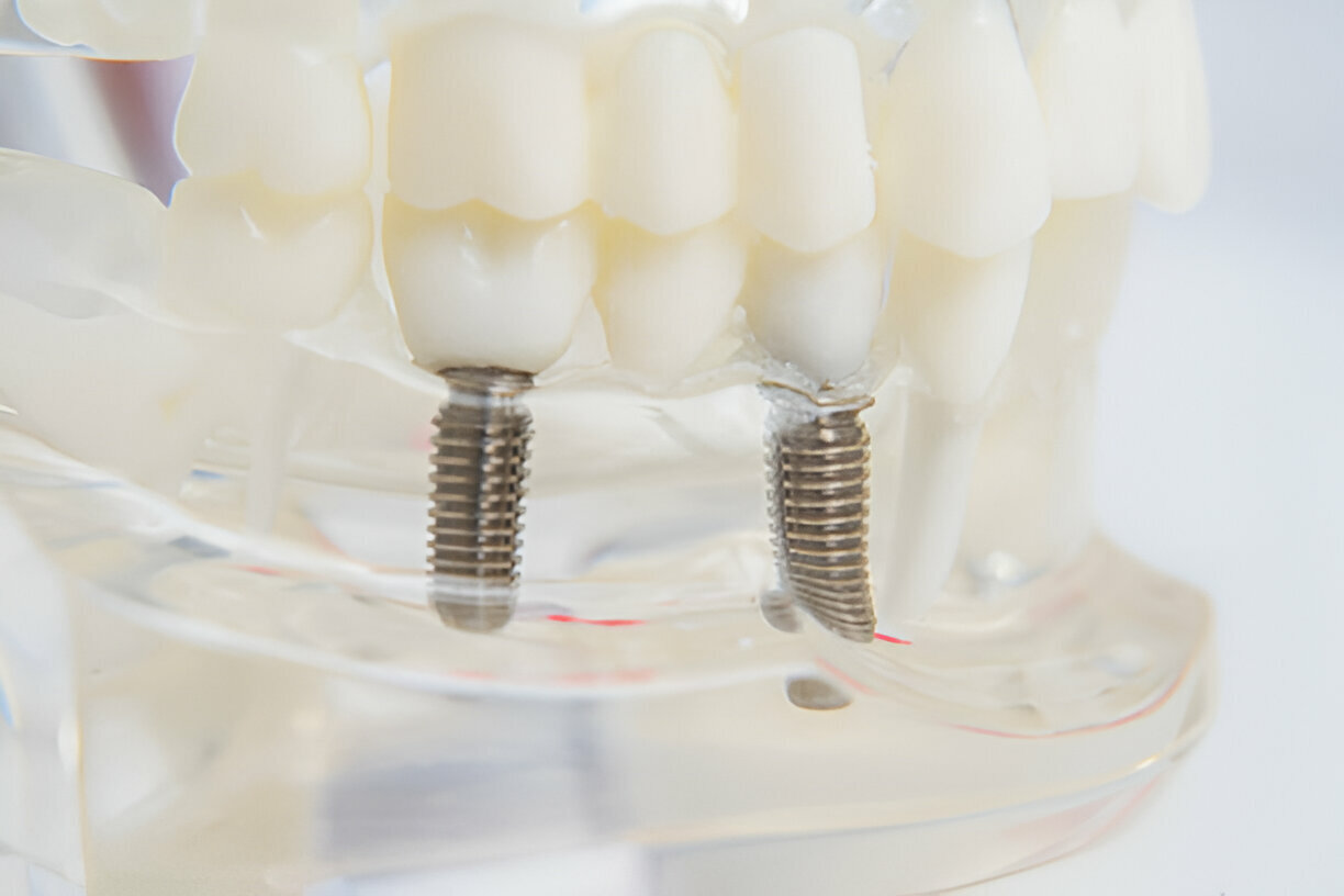 Common Causes of Loose Dental Implants: Prevention and Treatment_1