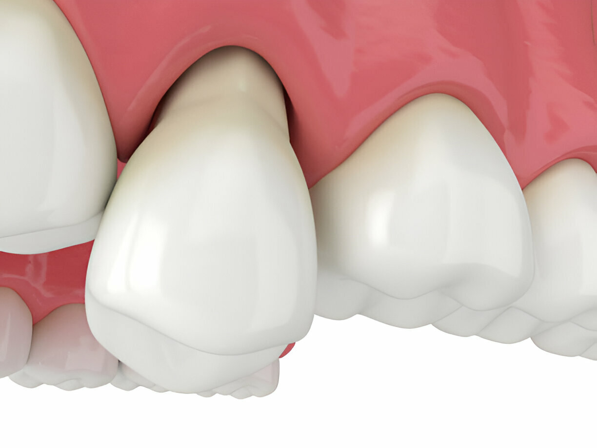 Common Causes of Loose Dental Implants: Prevention and Treatment_FI