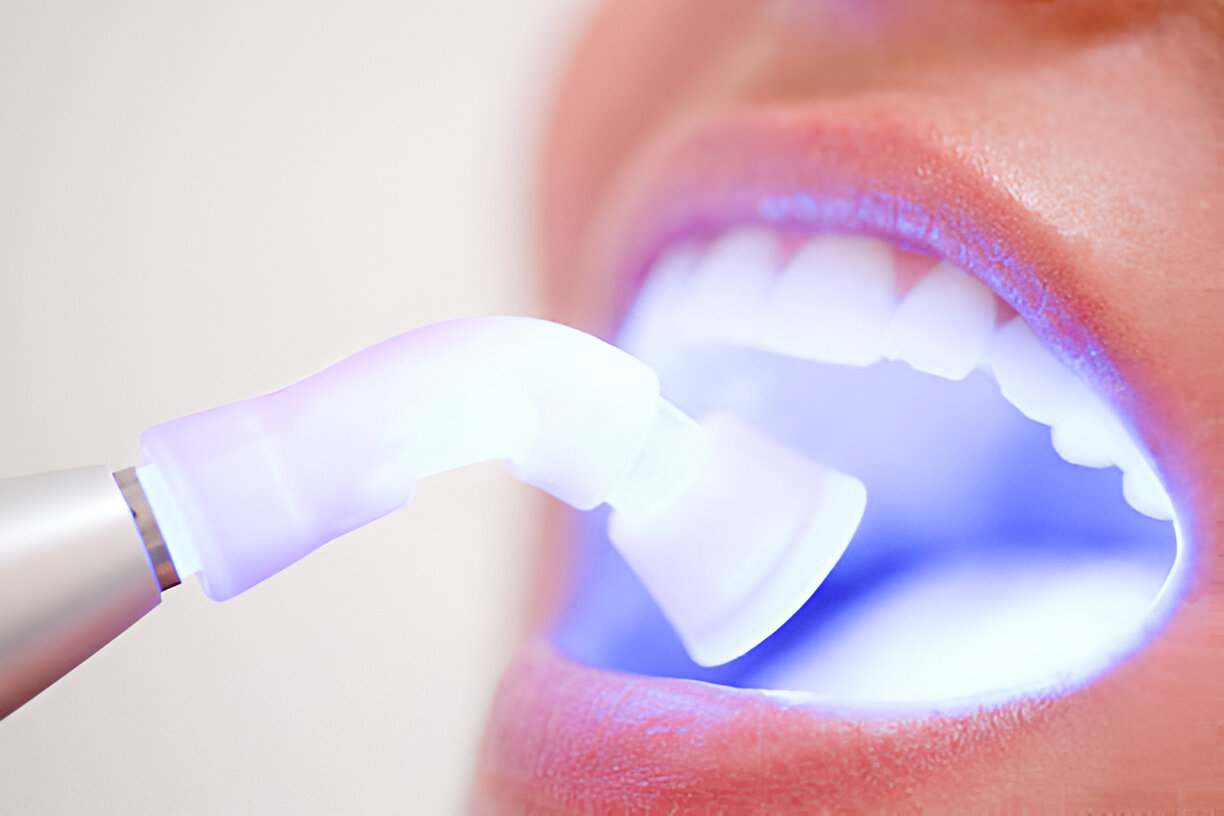 Professional Teeth Whitening: What to Expect and Why It Works_3