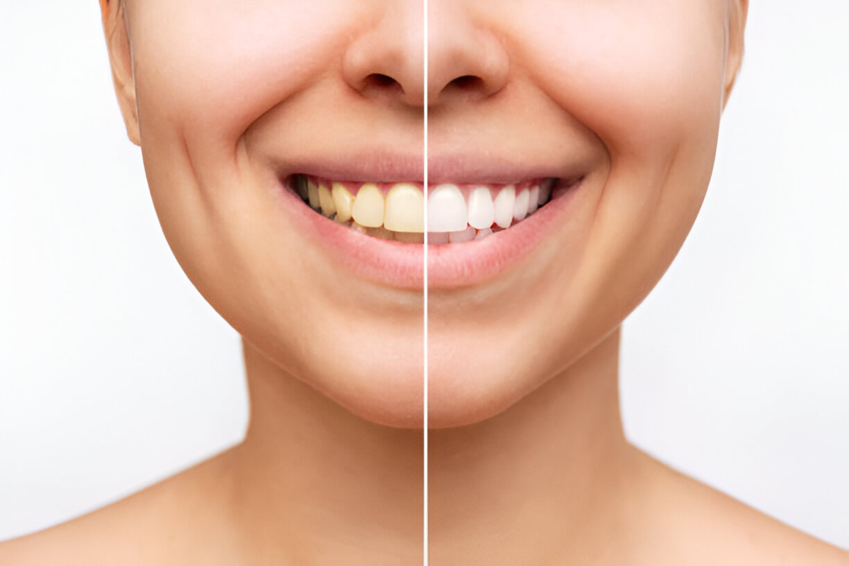 Professional Teeth Whitening: What to Expect and Why It Works_FI