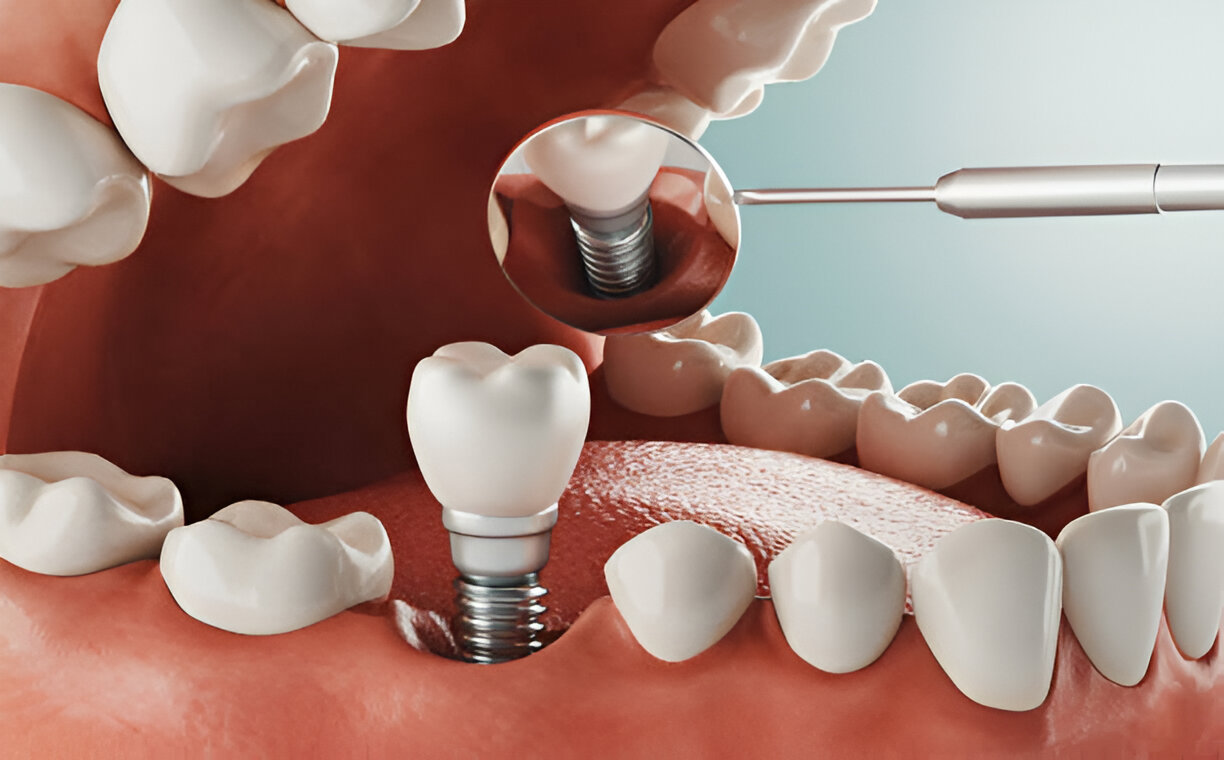 Transform Your Smile with Dental Implants at Cope Dentistry in Prairie Village, KS_FI