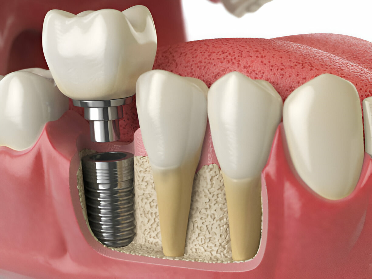 Dental Implants in Prairie Village, KS: Cope Dentistry's Trusted Solutions_1