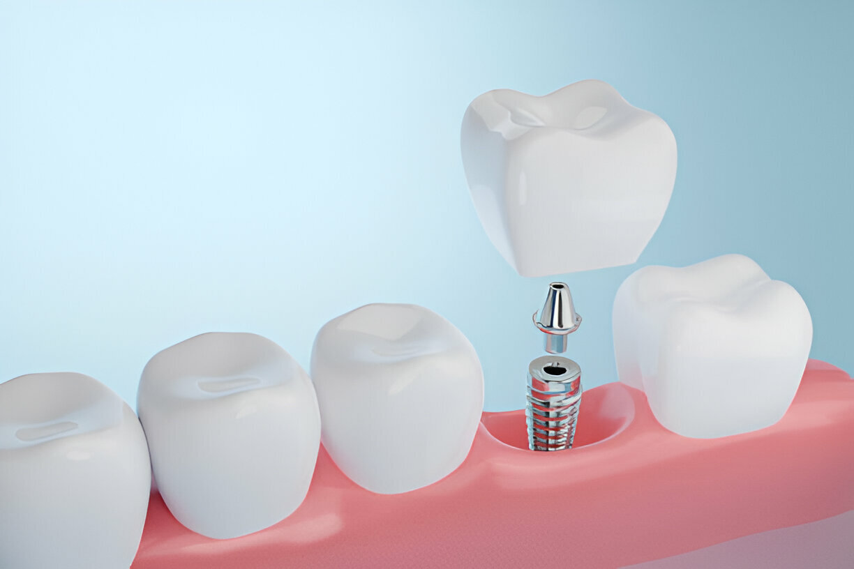 Dental Implants in Prairie Village, KS: Cope Dentistry's Trusted Solutions_FI